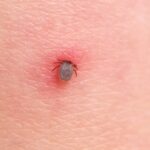 The tick bites the person