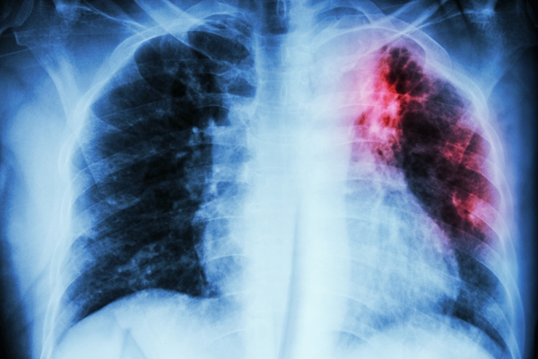 Pulmonary Tuberculosis
