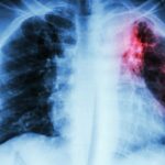 Pulmonary Tuberculosis