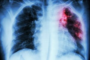 Pulmonary Tuberculosis